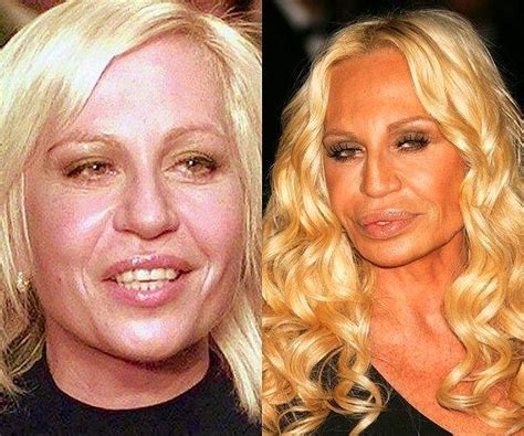 donatella versace estetiksiz hali